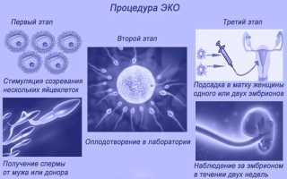 Плюсы и минусы ЭКО с донорской яйцеклеткой