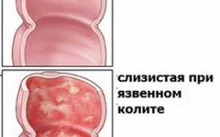 Как правильно делать клизму кружкой Эсмарха для очищения кишечника?