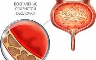 Первые признаки и симптомы цистита у детей: лечение воспалительного процесса лекарствами и народными средствами