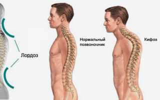 Искривление позвоночника: лордоз, кифоз и сколиоз
