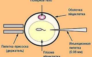 Процедура оплодотворения методом ПИКСИ