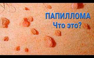 Папиллома изменила цвет