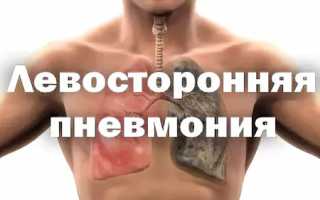 Левосторонняя пневмония – чем опасна? Лечение, симптомы