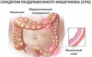 Основные причины синдрома раздраженного кишечника