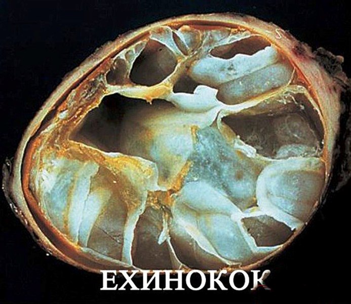 эхинококк
