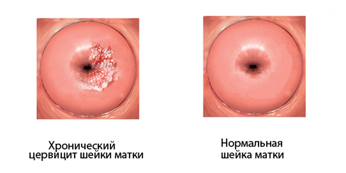 Цервицит шейки матки