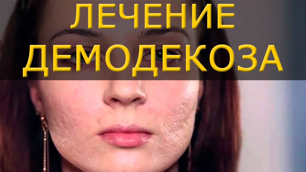 лечение демодекоза лица