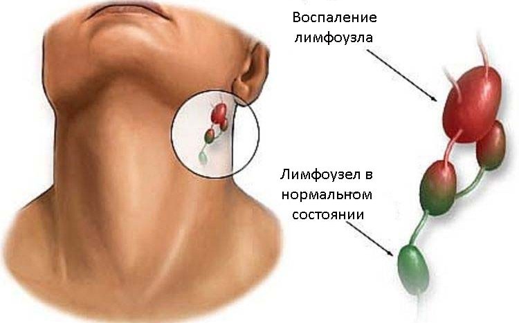 увеличение лимфоузлов