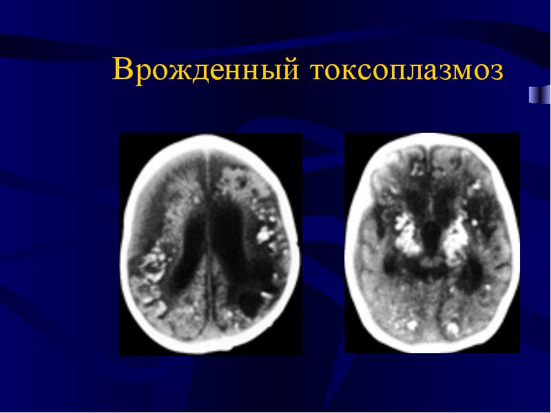 врожденный токсоплазмоз человека